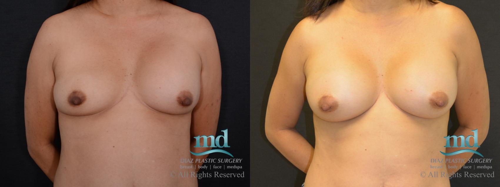 Before & After Breast Revision Case 104 View #1 View in Melbourne, FL