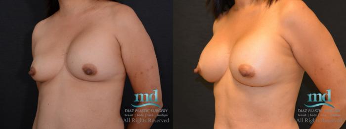 Before & After Breast Revision Case 104 View #2 View in Melbourne, FL