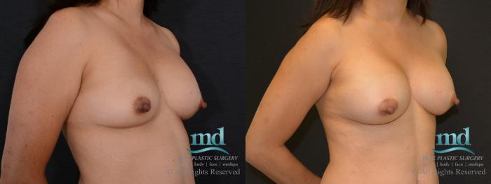 Before & After Breast Revision Case 104 View #4 View in Melbourne, FL