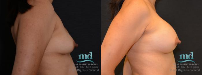 Before & After Breast Revision Case 104 View #5 View in Melbourne, FL