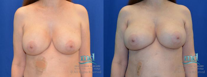Before & After Breast Revision Case 105 View #1 View in Melbourne, FL