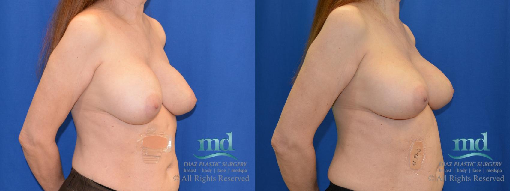 Before & After Breast Revision Case 105 View #2 View in Melbourne, FL