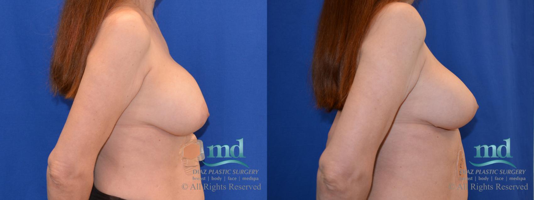 Before & After Breast Revision Case 105 View #3 View in Melbourne, FL