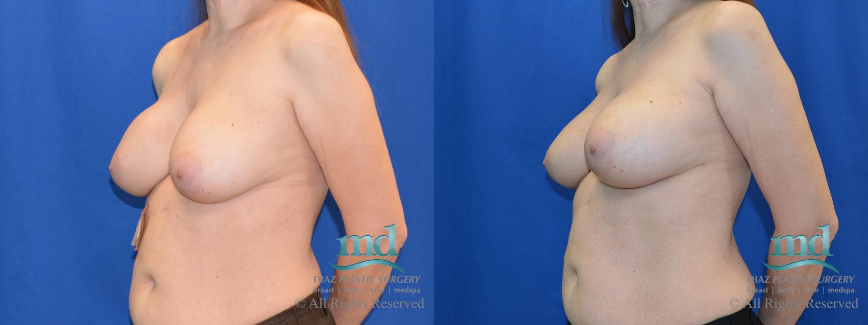 Before & After Breast Revision Case 105 View #4 View in Melbourne, FL