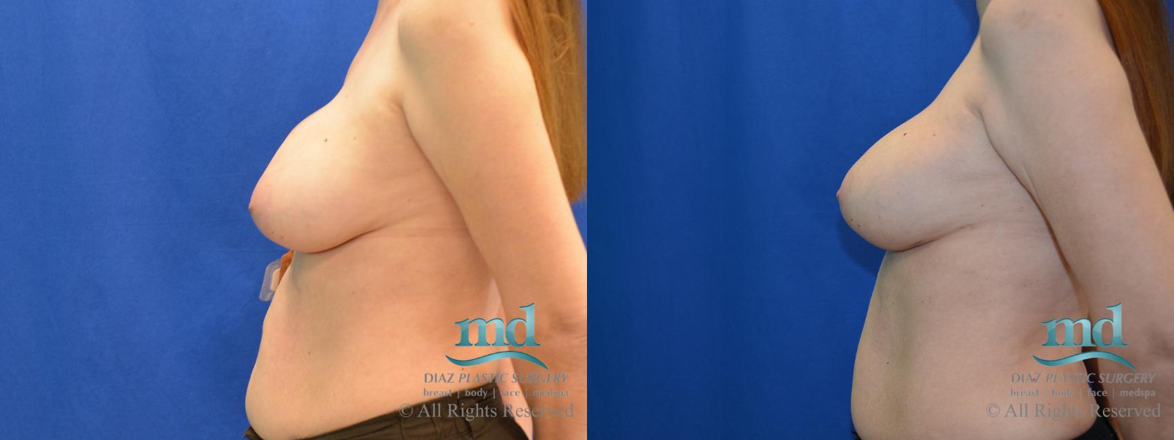 Before & After Breast Revision Case 105 View #5 View in Melbourne, FL
