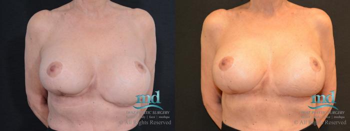 Before & After Breast Revision Case 106 View #1 View in Melbourne, FL