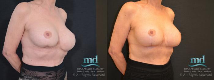 Before & After Breast Revision Case 106 View #2 View in Melbourne, FL