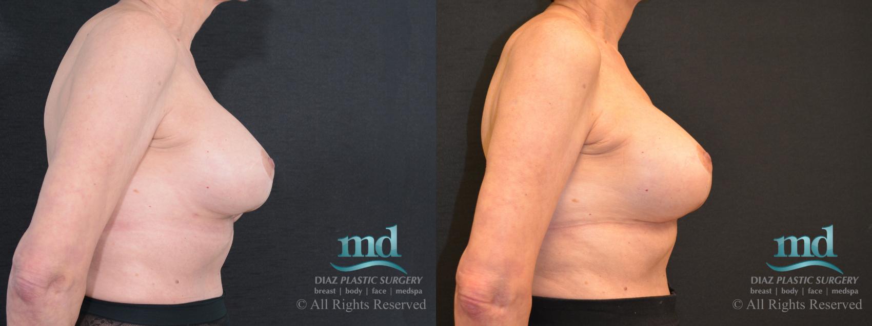 Before & After Breast Revision Case 106 View #3 View in Melbourne, FL