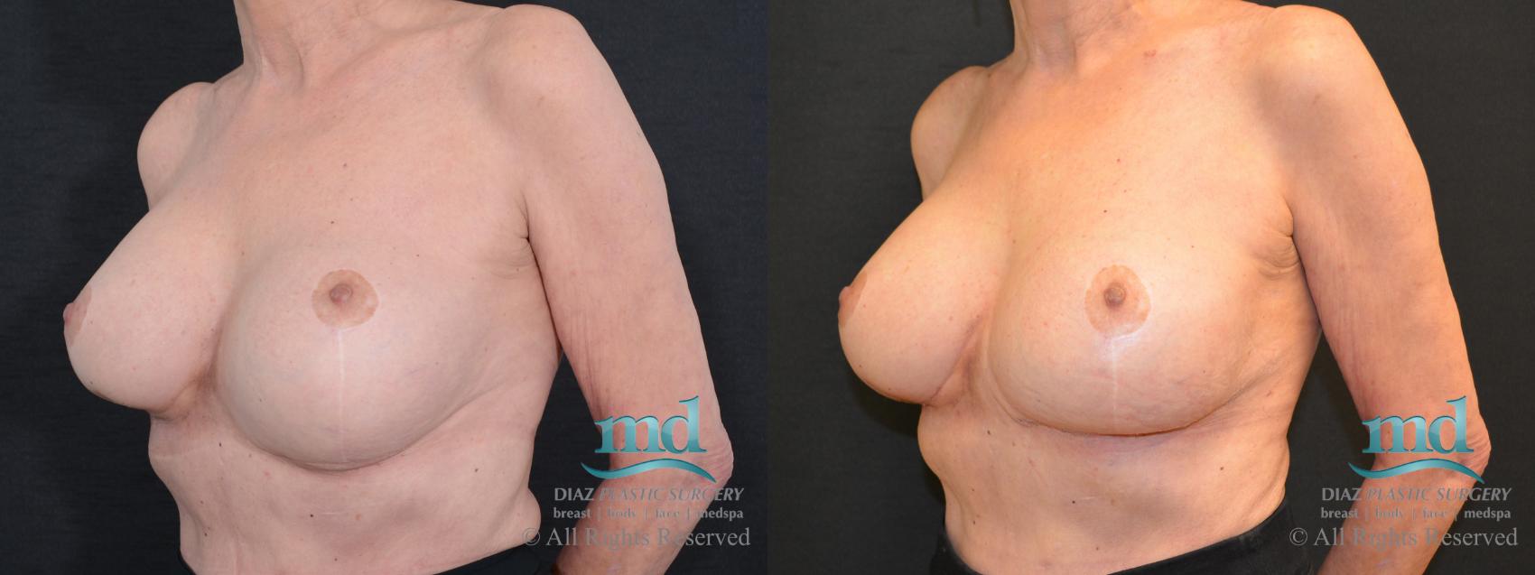Before & After Breast Revision Case 106 View #4 View in Melbourne, FL