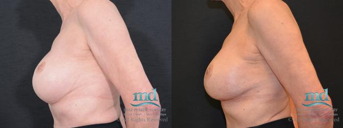 Before & After Breast Revision Case 106 View #5 View in Melbourne, FL