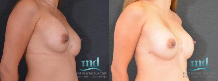 Before & After Breast Revision Case 107 View #2 View in Melbourne, FL