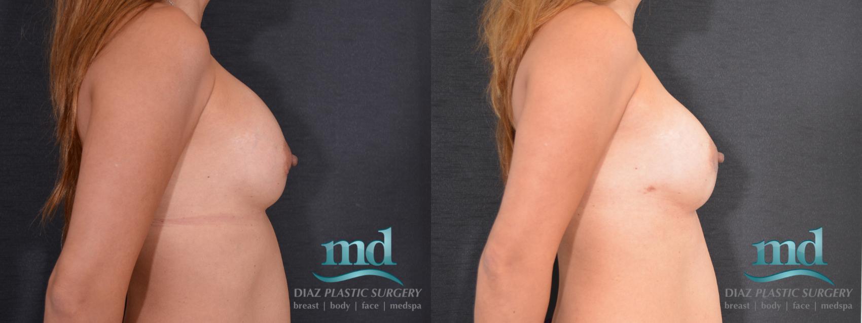 Before & After Breast Revision Case 107 View #3 View in Melbourne, FL