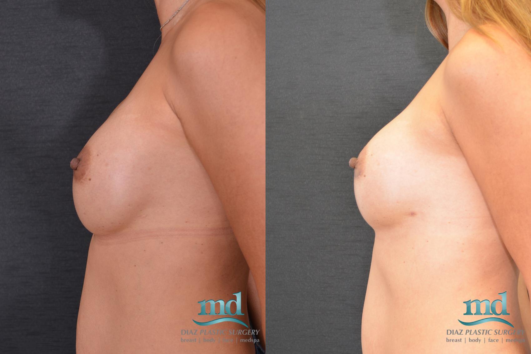 Before & After Breast Revision Case 107 View #5 View in Melbourne, FL