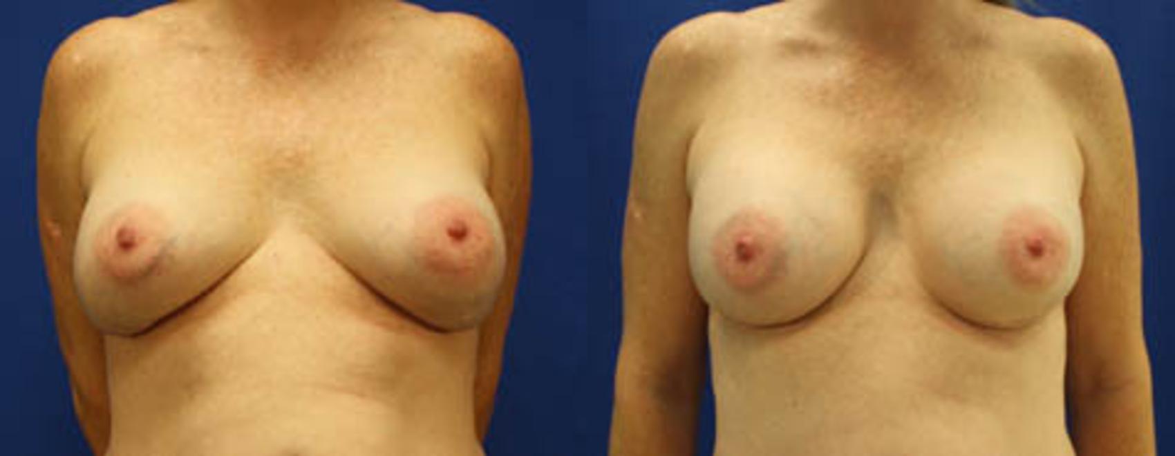 Before & After Breast Revision Case 20 View #1 View in Melbourne, Viera, Brevard County, FL