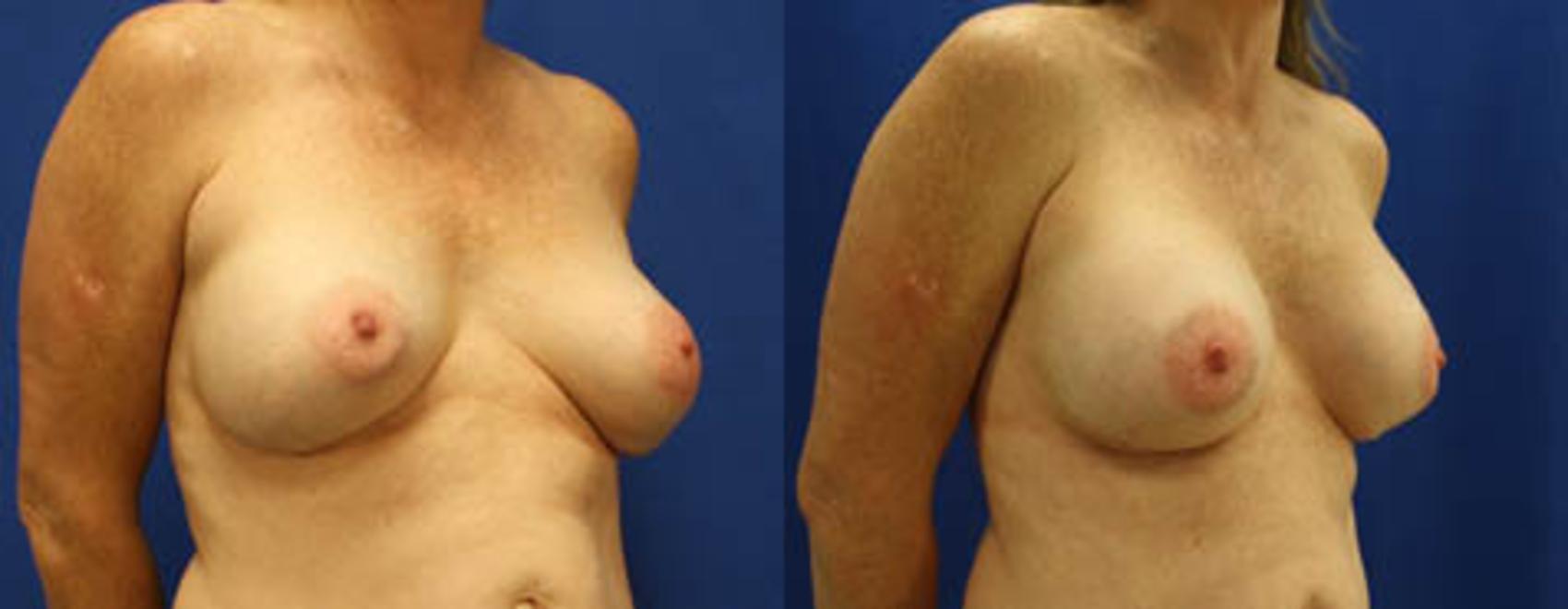 Before & After Breast Revision Case 20 View #2 View in Melbourne, FL
