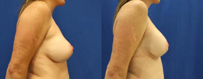 Before & After Breast Revision Case 20 View #3 View in Melbourne, FL