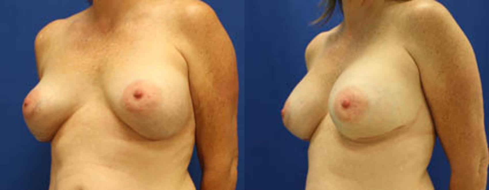 Before & After Breast Revision Case 20 View #4 View in Melbourne, FL