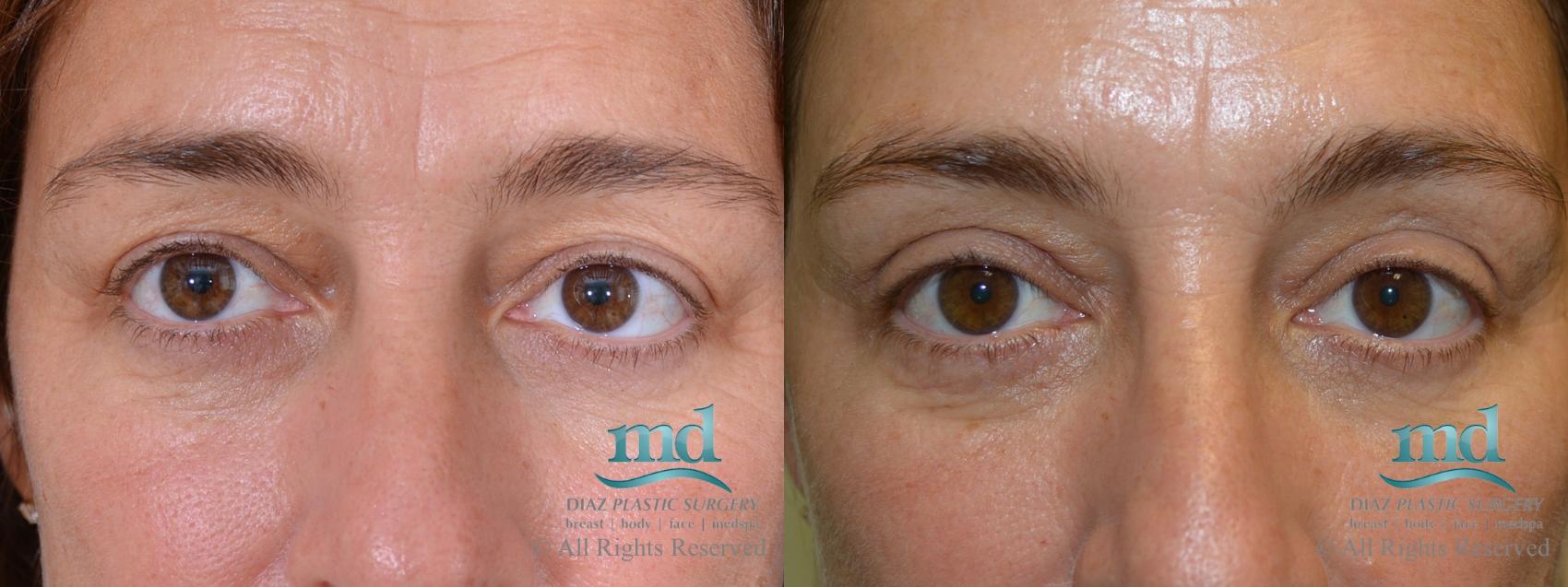 Before & After Eyelid Surgery Case 120 View #1 View in Melbourne, FL