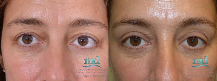 Before & After Eyelid Surgery Case 120 View #1 View in Melbourne, FL