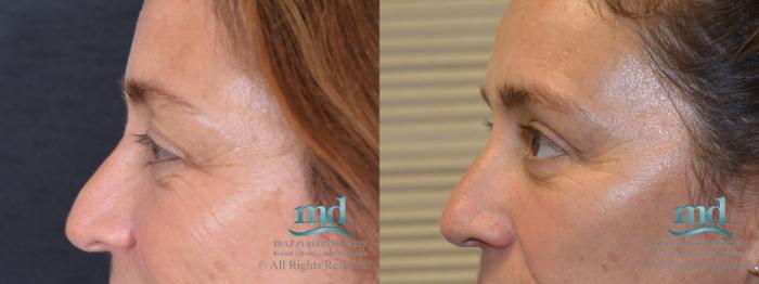 Before & After Eyelid Surgery Case 120 View #2 View in Melbourne, FL