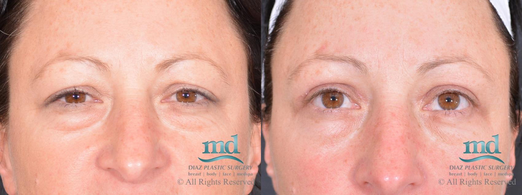 Before & After Eyelid Surgery Case 121 View #1 View in Melbourne, FL