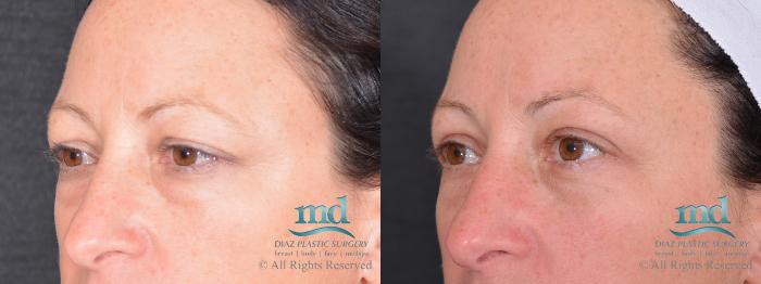 Before & After Eyelid Surgery Case 121 View #2 View in Melbourne, FL