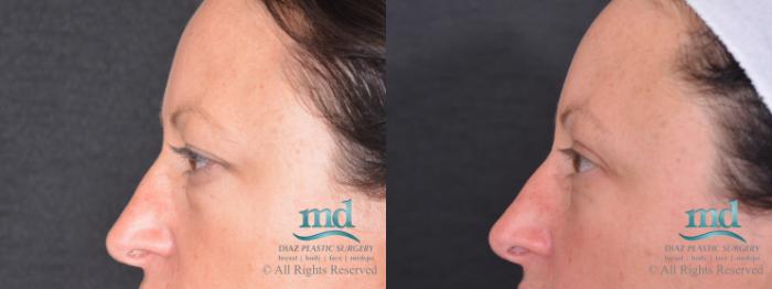 Before & After Eyelid Surgery Case 121 View #3 View in Melbourne, FL