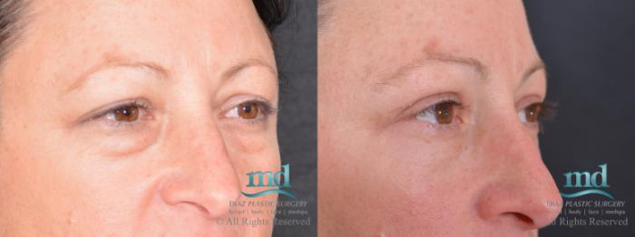 Before & After Eyelid Surgery Case 121 View #4 View in Melbourne, FL