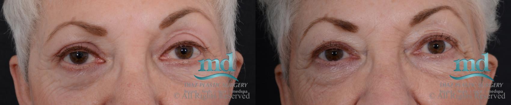 Before & After Eyelid Surgery Case 122 View #1 View in Melbourne, FL