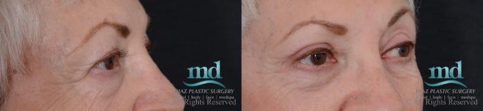 Before & After Eyelid Surgery Case 122 View #2 View in Melbourne, FL