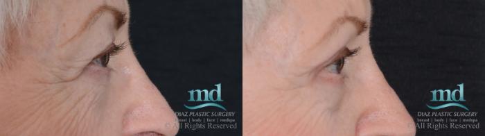 Before & After Eyelid Surgery Case 122 View #3 View in Melbourne, FL
