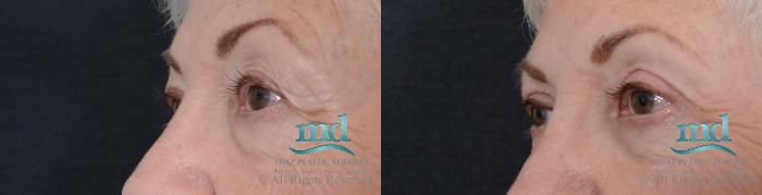 Before & After Eyelid Surgery Case 122 View #4 View in Melbourne, FL