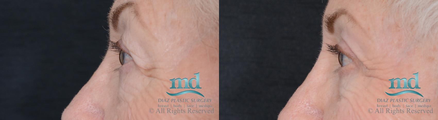 Before & After Eyelid Surgery Case 122 View #5 View in Melbourne, FL