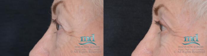 Before & After Eyelid Surgery Case 122 View #5 View in Melbourne, FL
