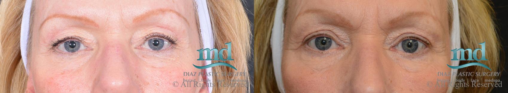 Before & After Eyelid Surgery Case 123 View #1 View in Melbourne, FL