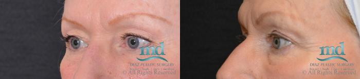 Before & After Eyelid Surgery Case 123 View #2 View in Melbourne, FL
