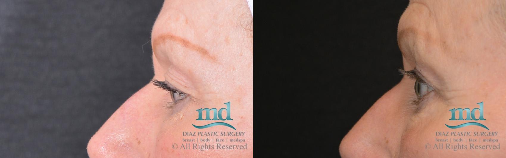 Before & After Eyelid Surgery Case 123 View #3 View in Melbourne, FL