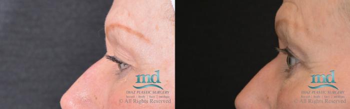 Before & After Eyelid Surgery Case 123 View #3 View in Melbourne, FL