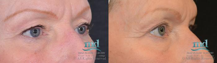 Before & After Eyelid Surgery Case 123 View #4 View in Melbourne, FL