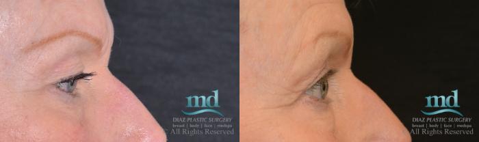 Before & After Eyelid Surgery Case 123 View #5 View in Melbourne, FL