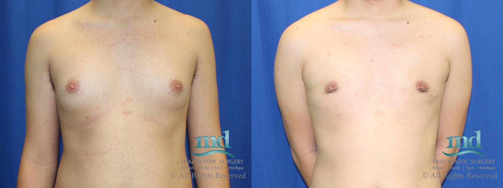 Before & After Gynecomastia Case 109 View #1 View in Melbourne, FL