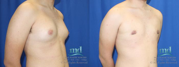 Before & After Gynecomastia Case 109 View #2 View in Melbourne, FL