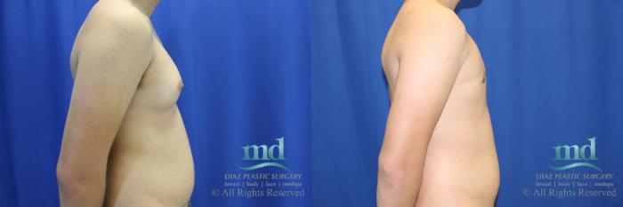 Before & After Gynecomastia Case 109 View #3 View in Melbourne, FL