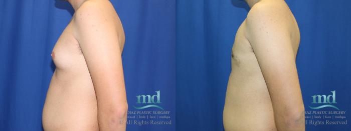 Before & After Gynecomastia Case 109 View #5 View in Melbourne, FL