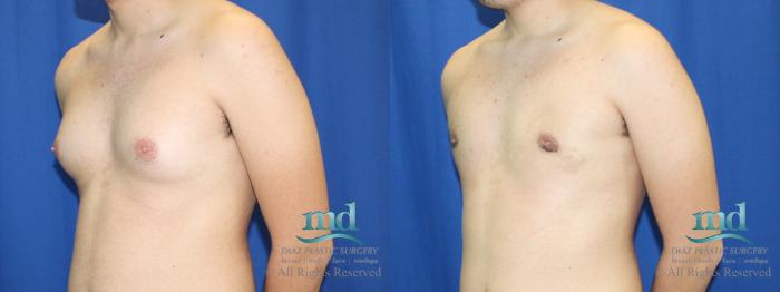 Before & After Gynecomastia Case 109 View #6 View in Melbourne, FL