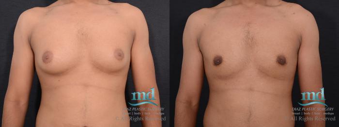 Before & After Gynecomastia Case 110 View #1 View in Melbourne, FL