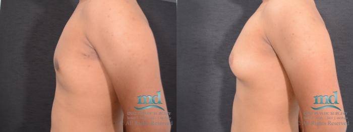 Before & After Gynecomastia Case 110 View #2 View in Melbourne, FL