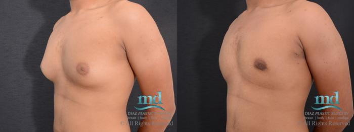 Before & After Gynecomastia Case 110 View #3 View in Melbourne, FL