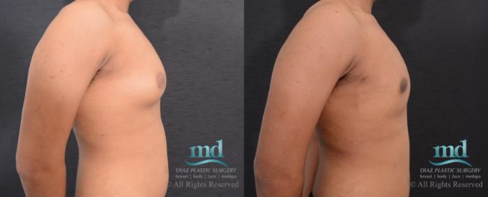Before & After Gynecomastia Case 110 View #4 View in Melbourne, FL