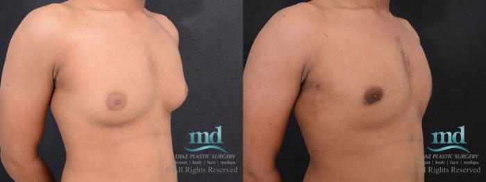 Before & After Gynecomastia Case 110 View #5 View in Melbourne, FL